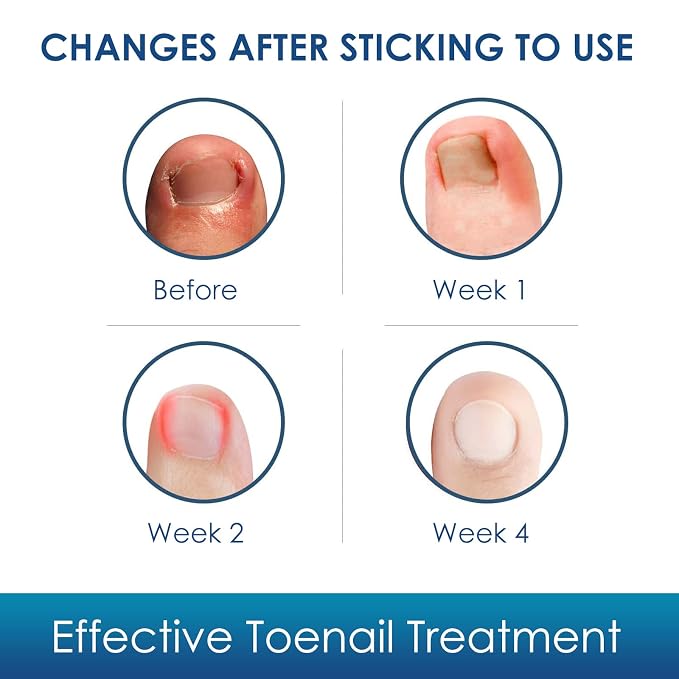 Ingrown Toenail Treatment, Professional-Grade Treatment - Image 4