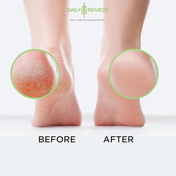 Tea Tree Oil Foot Soak with Epsom Salt - Image 5