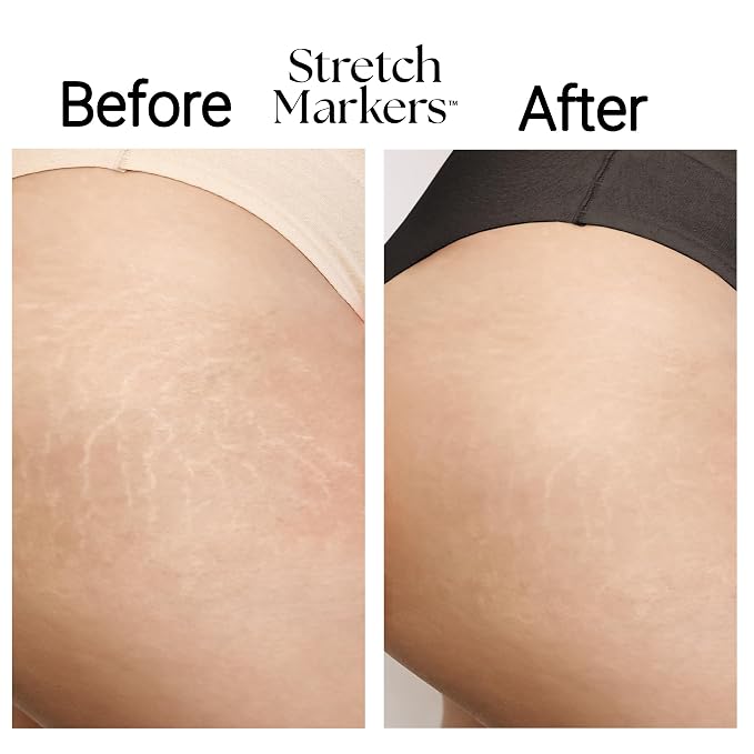 StretchMarkers Pregnancy Defender – Stretch Mark Cream - Image 6