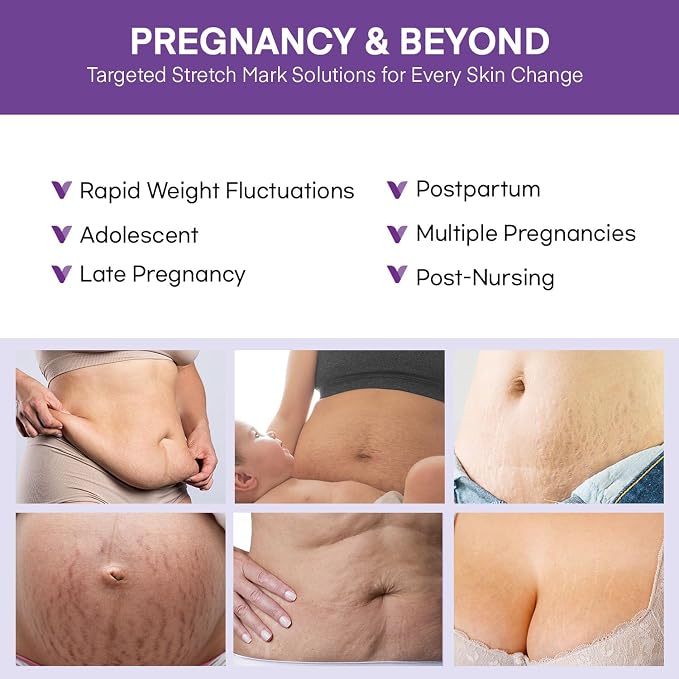 Stretch Mark Cream for Pregnant Women: Stretch Mark Treatment for Pregnancy - Image 4