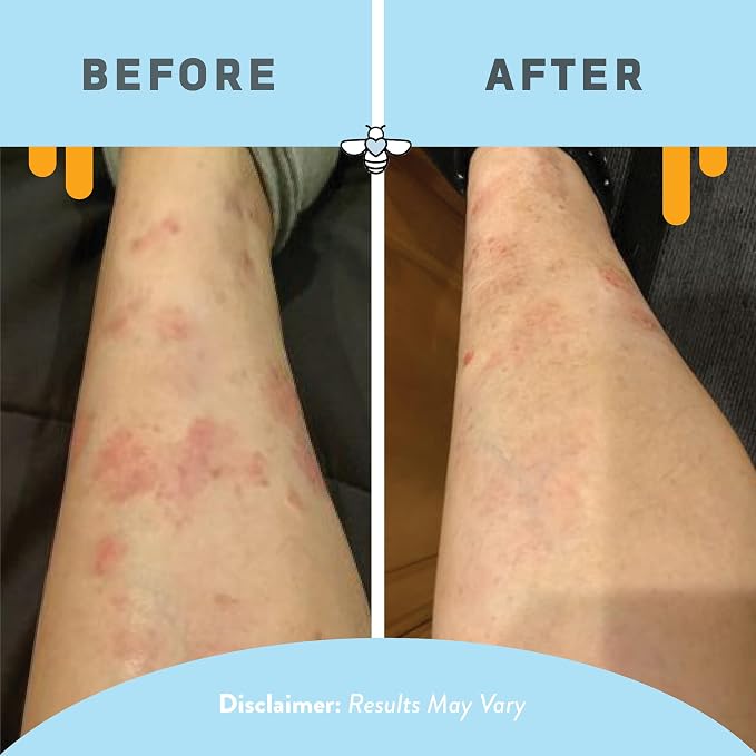 PSORIASIS HONEY Daily Moisturizing Body Lotion - Image 5
