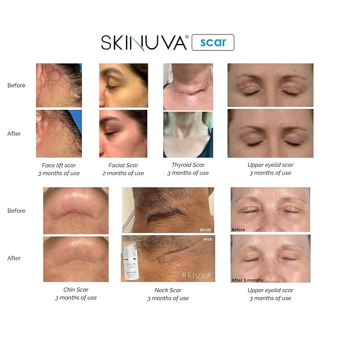 Skinuva® Next Generation Scar Cream - Image 7