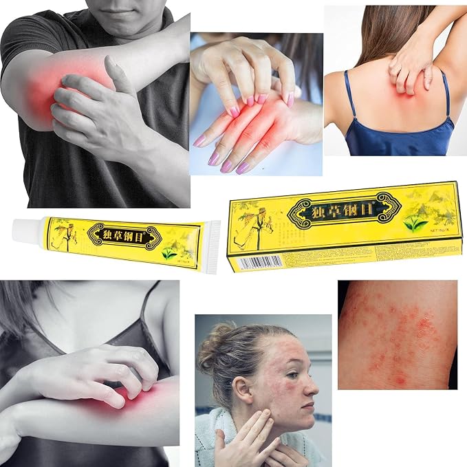 Chinese Herbal Eczema Psoriasis Creams Dermatitis, Eczema Pruritus Psoriasis - Image 2