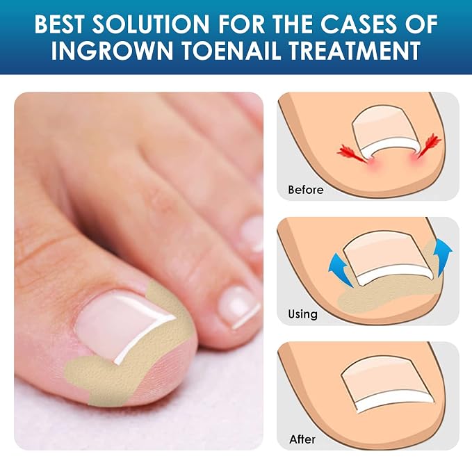 Ingrown Toenail Treatment, Professional-Grade Treatment - Image 6