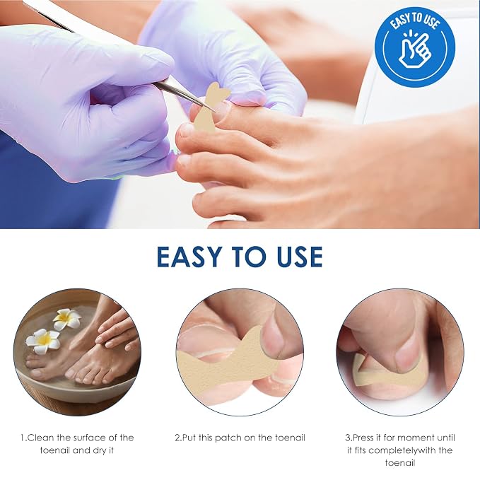 Ingrown Toenail Treatment, Professional-Grade Treatment - Image 7