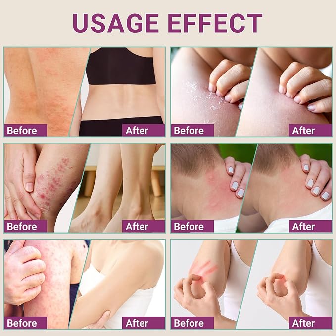 Anti Itch Cream, Extra Strength Anti-Itch Ointment, Relieves Rashes and Itching - Image 6
