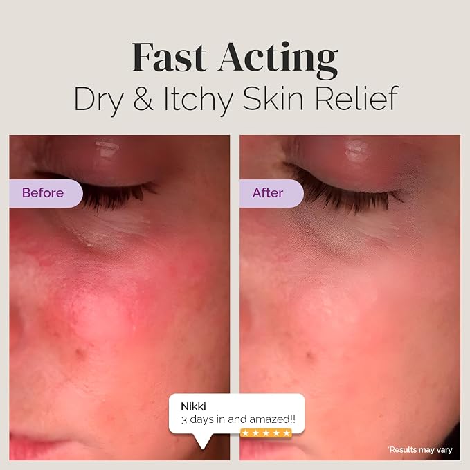 Puriya National Eczema Association Accepted Cream 4.5 oz, Dry Itchy Skin Relief - Image 3