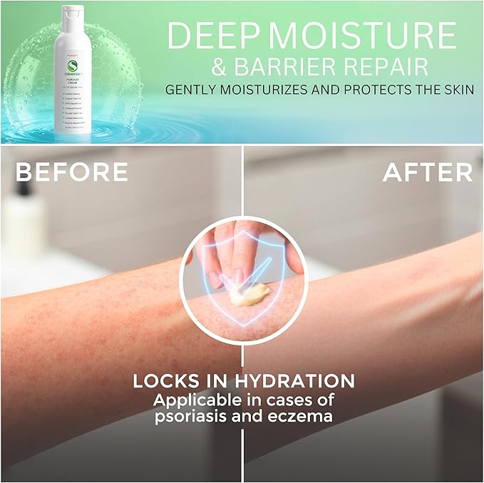 SORARESAL Psoriasis Cream – Comfort Remedy - Image 5
