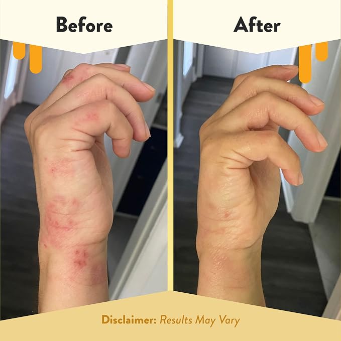 ECZEMA HONEY Antioxidant Body Oil - Image 4