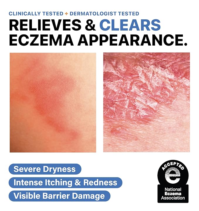 Eczema Cream for Adults & Kids – Hypoallergenic Barrier Repair Moisturizer - Image 3