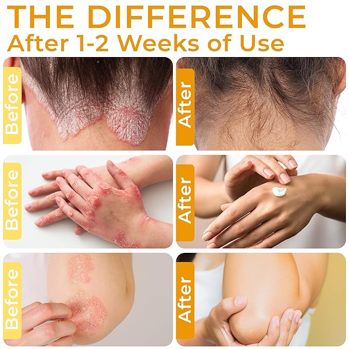 Psoriasis Cream for Itchy Scalp, Face & Body | Eczema Cream for Adults | - Image 3