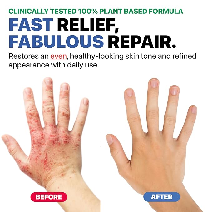 Eczema Cream for Adults & Kids – Hypoallergenic Barrier Repair Moisturizer - Image 5