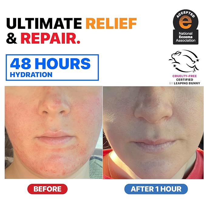 Eczema Cream for Adults & Kids – Hypoallergenic Barrier Repair Moisturizer - Image 8